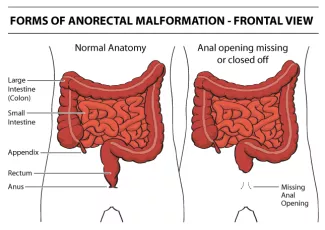 Anorectal Malformation UCSF Department of Surgery