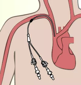 Long-Term Access Port Placement