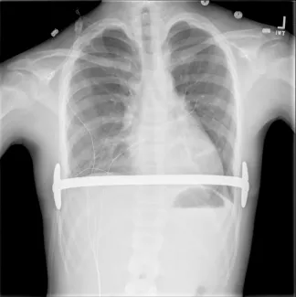 Chest radiography after the Nuss procedure. Four types of bar position;