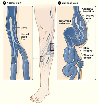 Varicose Veins  UCSF Department of Surgery