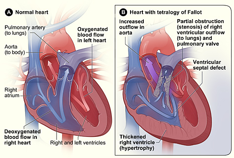 Tetralogy of Fallot | UCSF Department of Surgery